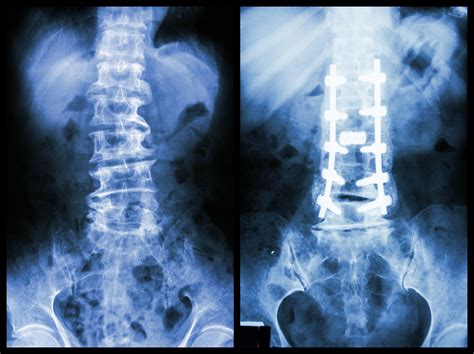 metal brackets pulled from spine|why is my spinal hardware removed.